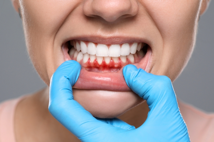 Caring for abscessed tooth dental emergency