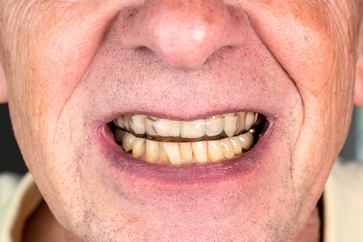 What Can Cause Tooth Discoloration and Stains