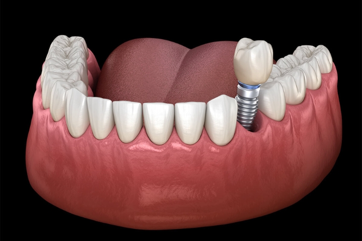 What Can You Eat After Dental Implant Surgery